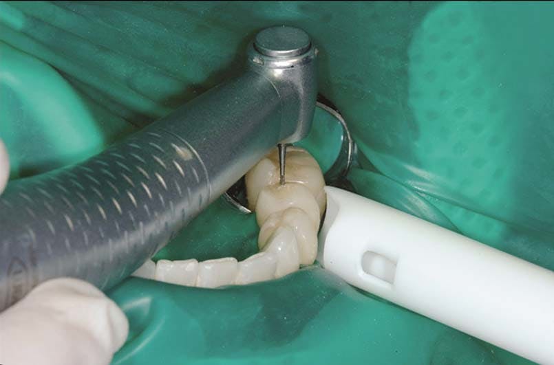 Operatif diş hekimliği nasıl keyifli, öngörülebilir ve üretken hale getirilir?