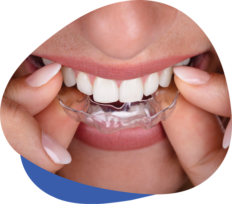 Bruxism Treatment | TMJ Treatment | Westerville Dental Associates