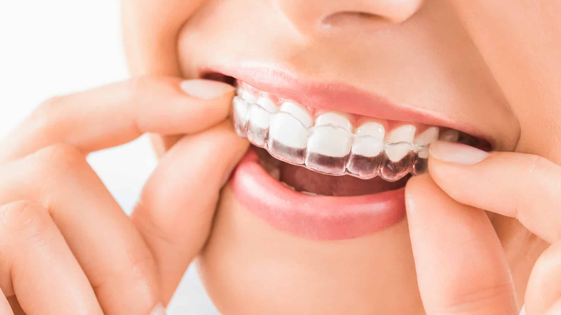 Invisalign