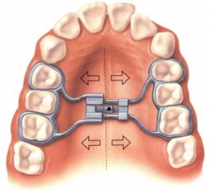Üst Çene Genişletici