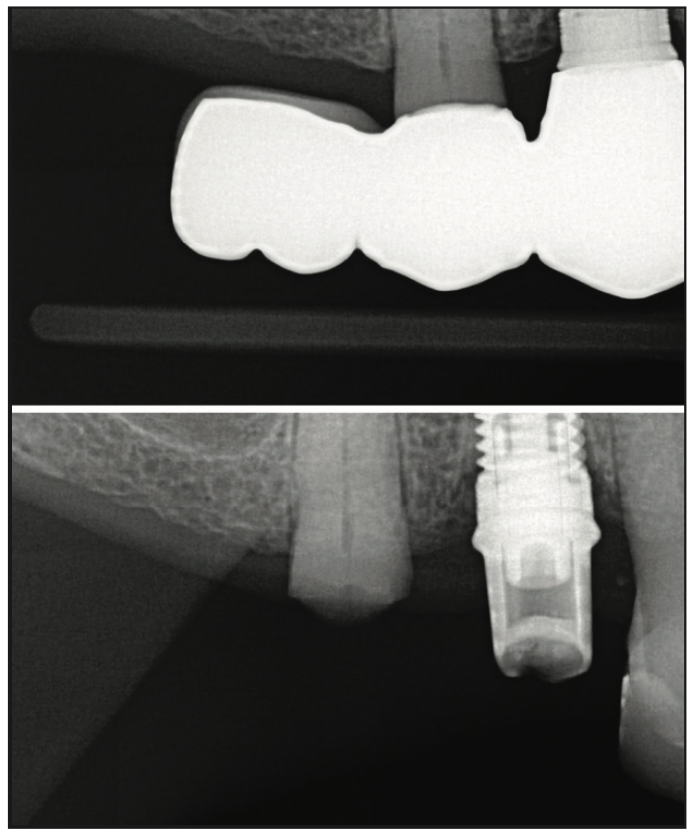 Şekil 12. Tam bir retainer dişinin tam kırılmasına neden olan arka kısım konsol köprüsünün önce ve sonra fotoğrafları.