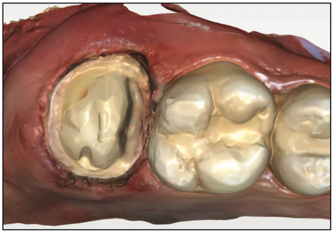 Şekil 2. 2 numaralı dişte endodontik tedavi ve çekirdek yapımından sonraki taç hazırlığını takiben ağız içi tarama.