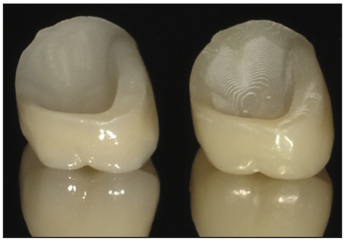 Şekil 5. Frezelenmiş IPS e.max taç (sol) ve basılı SprintRay Ceramic Crown'un (sağ) diş tarafının görünümü. Basılı seramik reçine restorasyonu, frezlenmiş yüzeye kıyasla taç malzemesine sementasyon yapışmasını artıran daha kaba bir yüzey gösterdi.