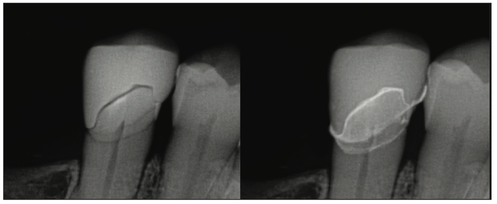 Şekil 12. No. 29'da basılı SprintRay Ceramic Crown restorasyonunun deneme sırasındaki radyografisi (sol) ve sementasyon sonrası (sağ).